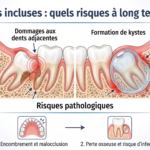 Image montrant une dent incluse et ses impacts potentiels